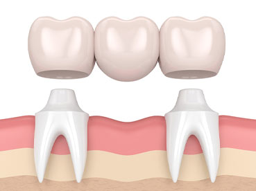 Dental Bridge