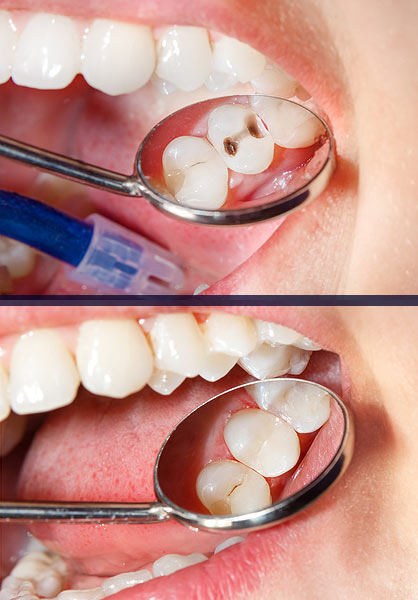 Dental Fillings