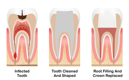 Diagram of three teeth showing the steps of a root canal that involve cleaning out an infected tooth, filling it and adding a crown.